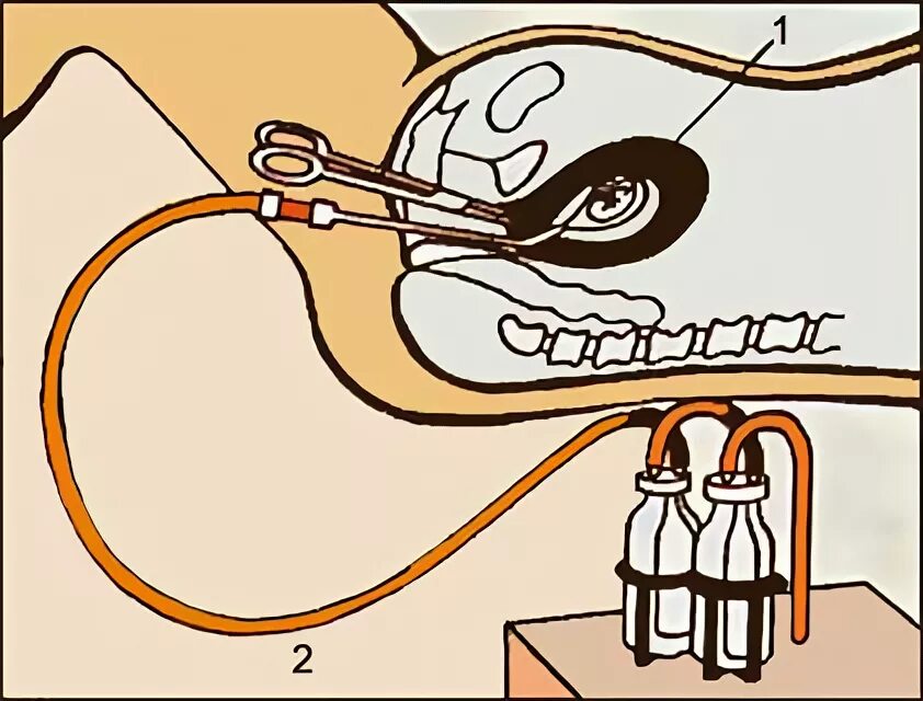 Вакуум аспирация аборт. Метод вакуум аспирации. После вакуумный аспирация форум