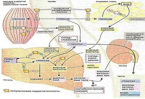 Дефицит инсулина
