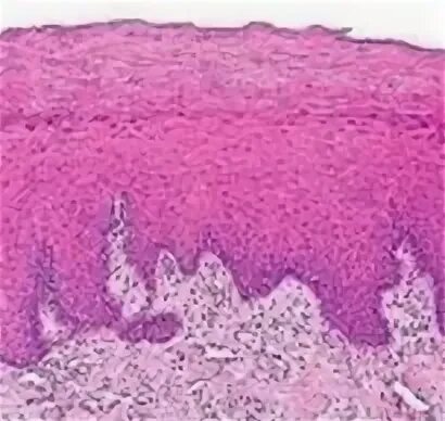 Dermatopathology Made Simple - Inflammatory: Psoriasiform Reaction Pattern