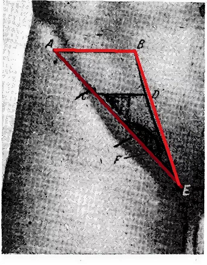 Паховый треугольник анатомия. Паховый треугольник гессельбаха. Паховый треугольник гессельбаха. Бедренный треугольник скарпа. Треугольник гессельбаха.