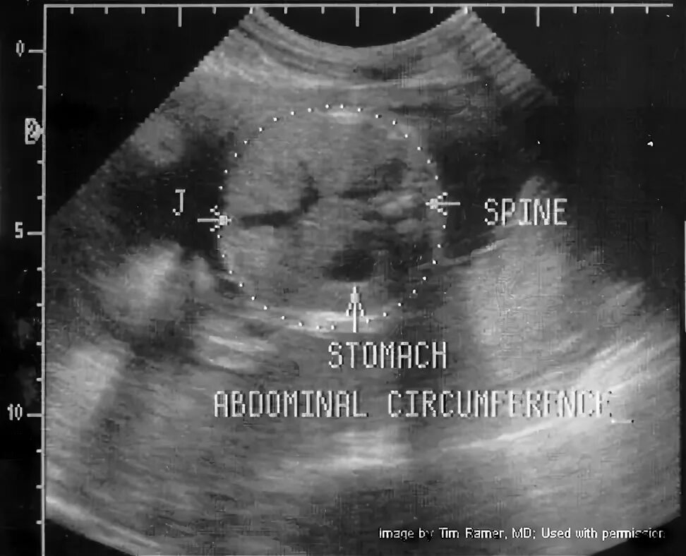 Эхография плода желудок. Желудок не визуализируется у плода на УЗИ. Окружность живота плода УЗИ. На узи виден желудок
