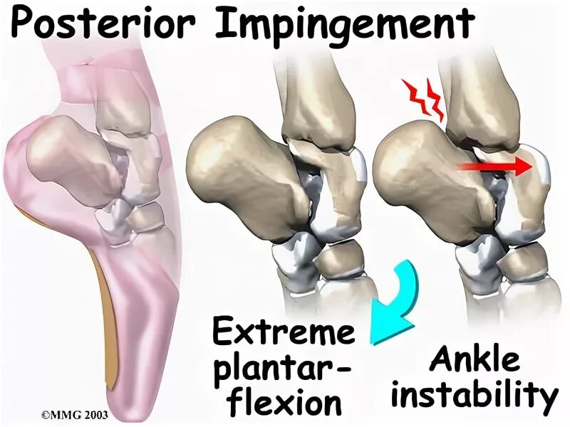 Задний отросток таранной кости импиджмент. Задний импинджмент голеностопного сустава. Gthtlybqимпинджмент голеностопного сустава. Латеральный импинджмент голеностопного сустава.