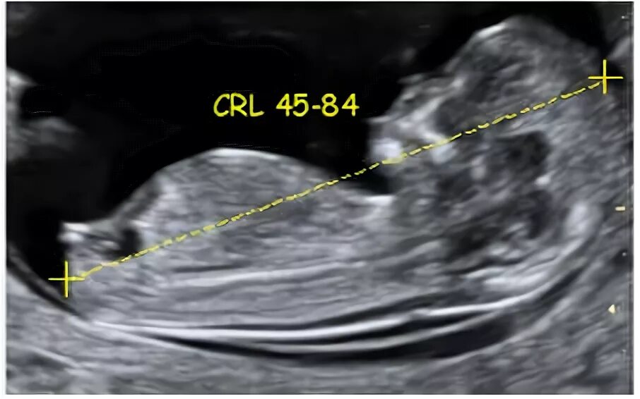 Ктр прочее. КТР 6.6 мм. УЗИ КТР плода что это. КТР 10мм по УЗИ.