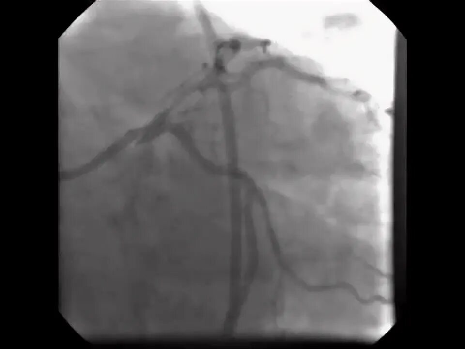 Стентирование пмжв. Стентирование пмжв. Что такое стентирование пмжв лка. Стентирование пмжв. Стентирование пмжв сте.