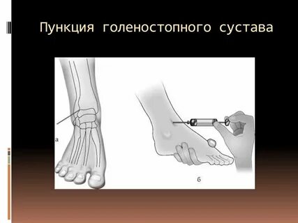 Укол в сустав голеностоп