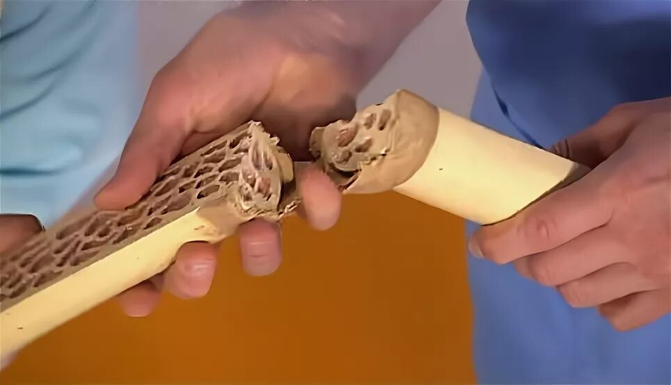 Рак костей можно вылечить