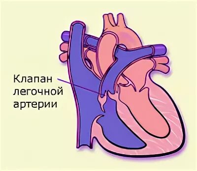 Изолированный стеноз. Стеноз устья легочной артерии гемодинамика. Стеноз клапана легочной артерии гемодинамика. Впс изолированный стеноз легочной артерии. Изолированный стеноз.