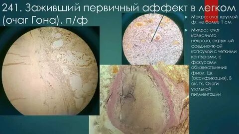 Первичный туберкулезный аффект