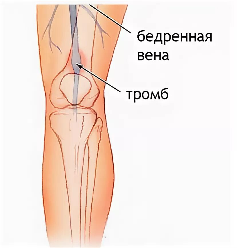 Тромбоз бедренных вен. Поверхностная бедренная Вена тромбоз. Поверхностный флебит, тромбофлебит. Флебит тромбофлебит нижних. Флеботромбоз бедренно подколенного сегмента.