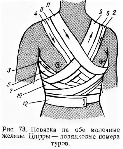 Повязка на молочные железы алгоритм. Повязка на обе молочные железы техника наложения. Повязка Вельпо схема. Повязка Вельпо на молочную железу алгоритм. Повязка на обе молочные железы алгоритм.