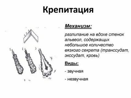 Крепитация отмечается при