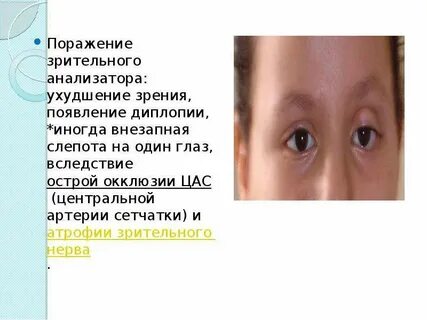 Диплопия это