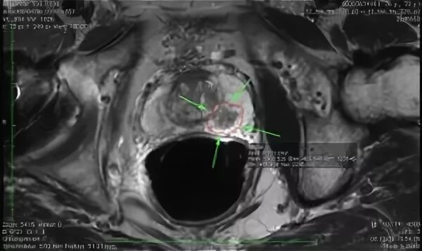 Опухоль предстательной железы кт. Предстательная железа на кт. Гиперплазия предстательной железы мрт. Аденома простаты мрт