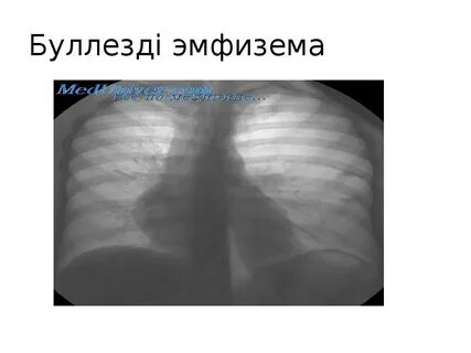 Грудная эмфизема