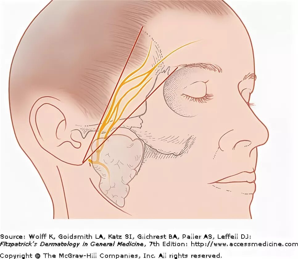Лицевой нерв. Воспаление лицевого нерва. Лицевой нерв ветви на лбу. Рассечение лицевого нерва.