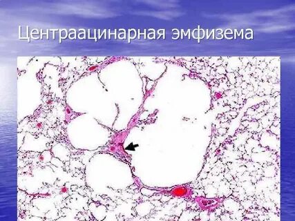 История болезни эмфизема