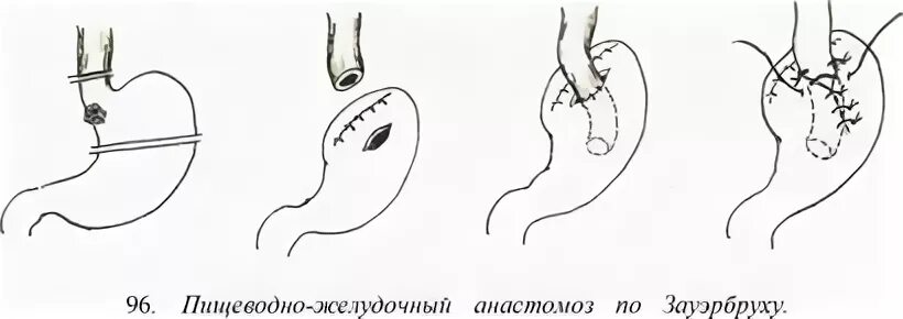 Пищеводно-кишечный анастомоз по Давыдову. Пищеводно желудочный анастомоз схема. Пищеводно желудочный венозный анастомоз. Анастомоз пищевода