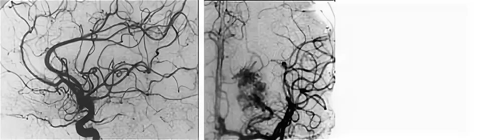 Сосудистая аномалия. Артерио венозная мальформация. Артериовенозная мальформация патанатомия. Эмболизация АВМ головного мозга. Артериовенозная фистула в головном мозге.