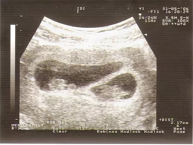УЗИ 8 недель беременности двойня. УЗИ 8 недель многоплодная беременность. УЗИ 8-9 недель беременности двойня. Двойня 8 недель
