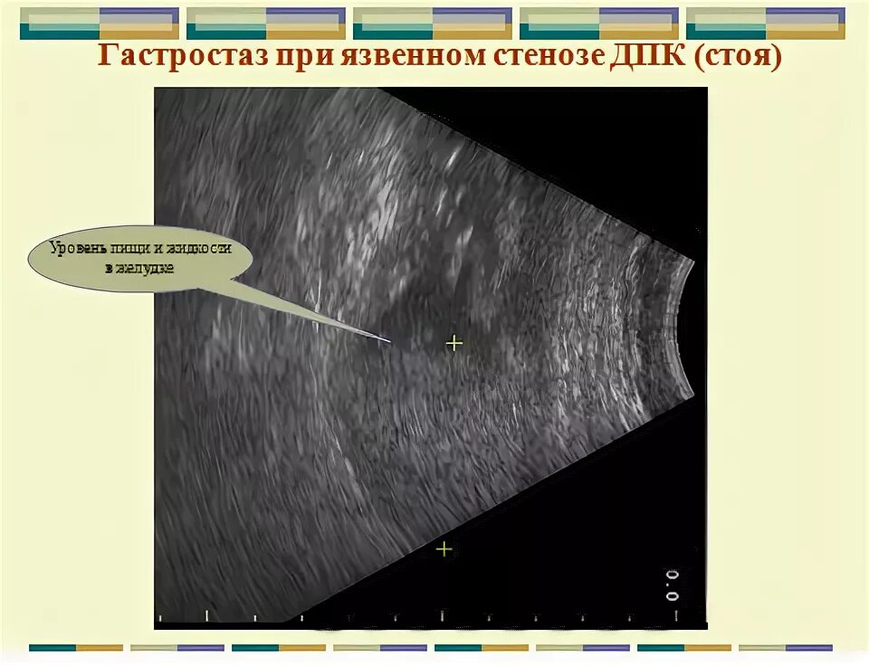 гастростаз что это такое. узи признаки гастростаза. гастростаз что это такое. нарушение эвакуации пищи. острый панкреатит купирование болевого синдрома.