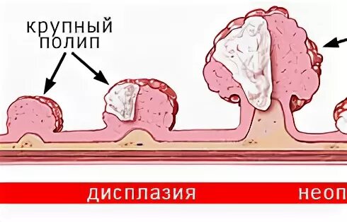 Полип прямой мкб. Малигнизация полипов желудка.