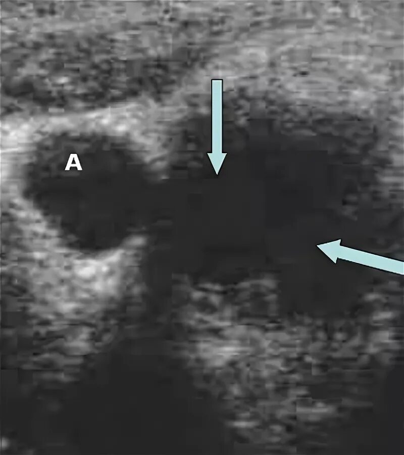 лимфоузлы видны узи