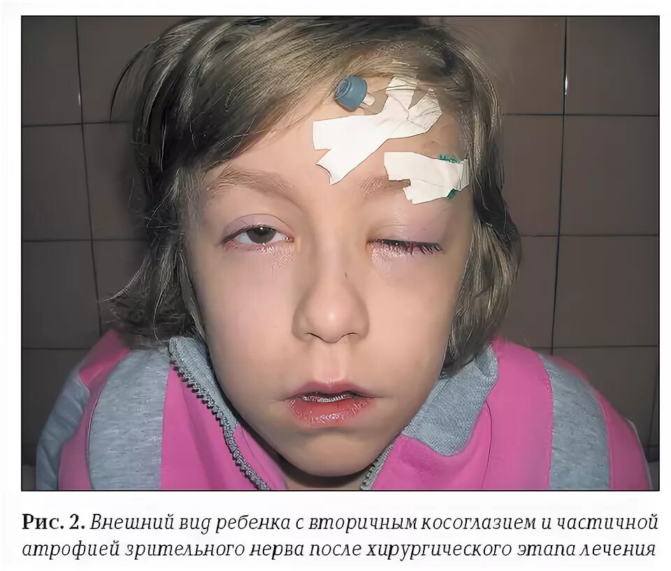 Атрофия зрительного нерва у детей. После операции на косоглазие. Операция на глаза атрофия зрительного нерва. Косоглазие у детей после операции. Заклейки для глаз детские.