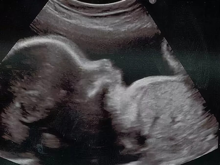 Замершая 14 недель. УЗИ 14 недель беременности. 14 Недель беременности фото плода на УЗИ. Снимки УЗИ на 14 неделе беременности. Малыш на 14 неделе беременности УЗИ.