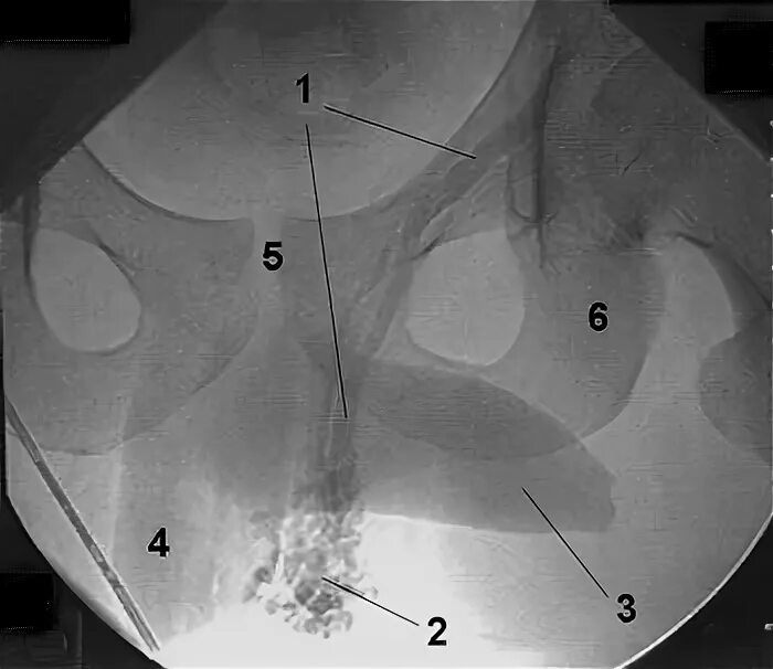 эндоваскулярная варикоцеле