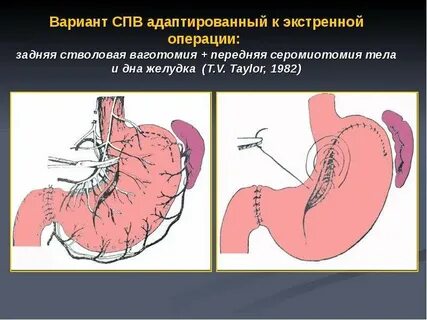 Язва хирургия
