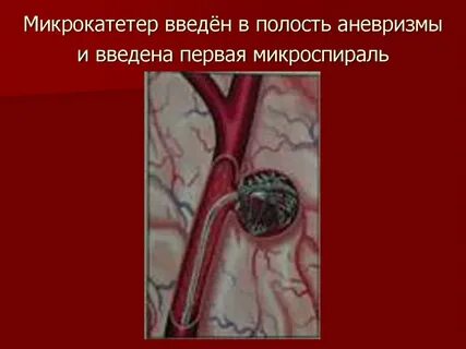 Восстановление после операции аневризмы