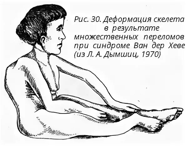 Синдром ван дер