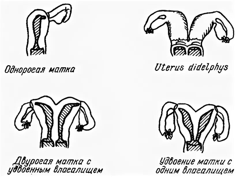 Аномалия развития матки однорогая. Однорогая матка с рудиментарным рогом. Строение двурогой матки. Однорогая и двурогая матка.