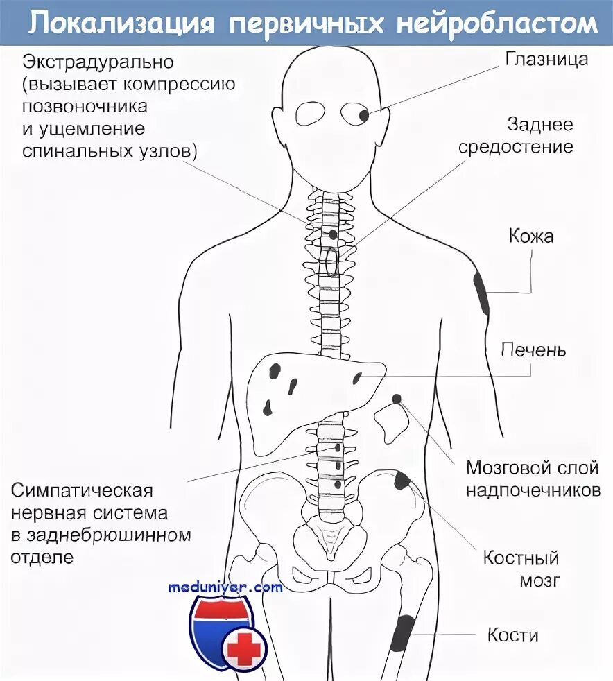 Локализация 13. Нейробластома локализация. для нейробластом характерна локализация:. нейробластома надпочечника. симптомы нейробластомы забрюшинного пространства.