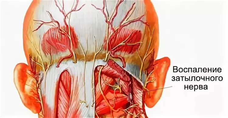 Затылочный нерв затылочный воспаление. Невралгия затылочного нерва. Неврит затылочного нерва симптомы. Подзатылочный нерв защемление. Невропатия затылочного