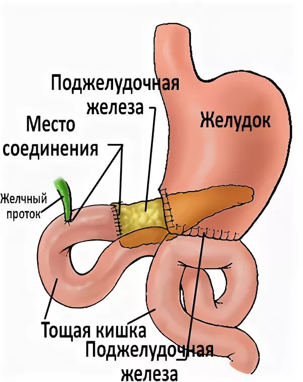 Делают ли операцию на поджелудочную. Самопереваривание поджелудочной железы. Поджелудочная железа операция. Операция на поджелудочную железу. Резекция хвоста поджелудочной железы.