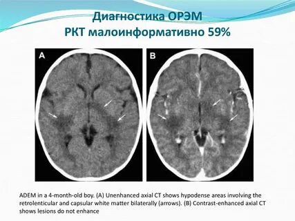 Острый рассеянный