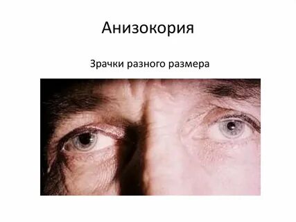 Разные зрачки болезнь