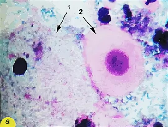 дисплазия шейки матки hpv. клетки буккального эпителия. клетки с пикнотичным ядром. однослойный плоский эпителий строение ткани. клетки парабазального слоя многослойного плоского эпителия.