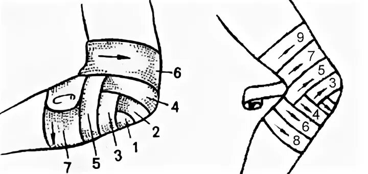 Повязка на локтевой сустав техника наложения. Перевязка черепашья на локтевой сустав. Черепашья расходящаяся повязка. Черепашья повязка на локоть сходящаяся. Как перевязывать колено