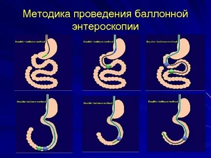 Энтероскопия