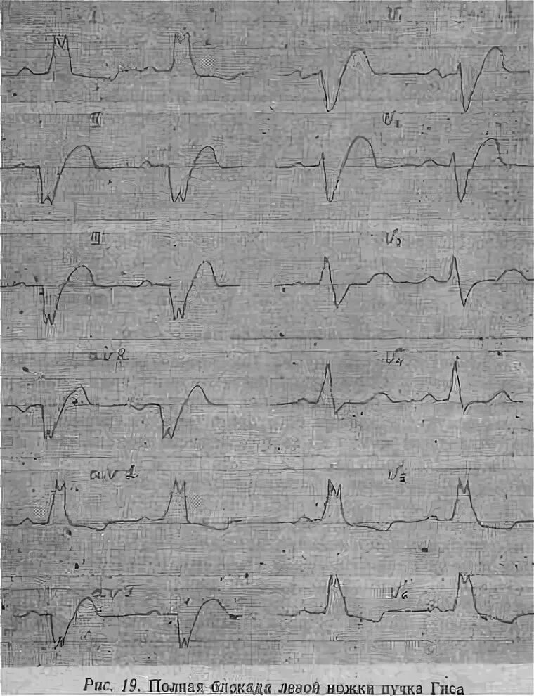 Блокада правого желудочка. Блокада левого желудочка пучка Гиса. Пучок левой ножки Гиса блокада пучка. Полная блокада левого желудочка пучка Гиса. Гипертрофия левой ножки пучка Гиса.