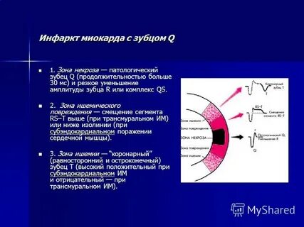 Варианты инфаркта миокарда