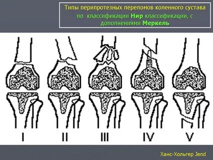 Перипротезная инфекция суставов