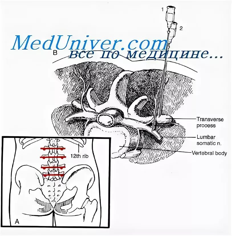 Паравертебральная поясничная блокада. Паравертебральная блокада пояснично-крестцовый. Паравертебральная блокада методика. Техника паравертебральной блокады поясничного отдела позвоночника. Техника выполнения блокады поясничного отдела позвоночника.