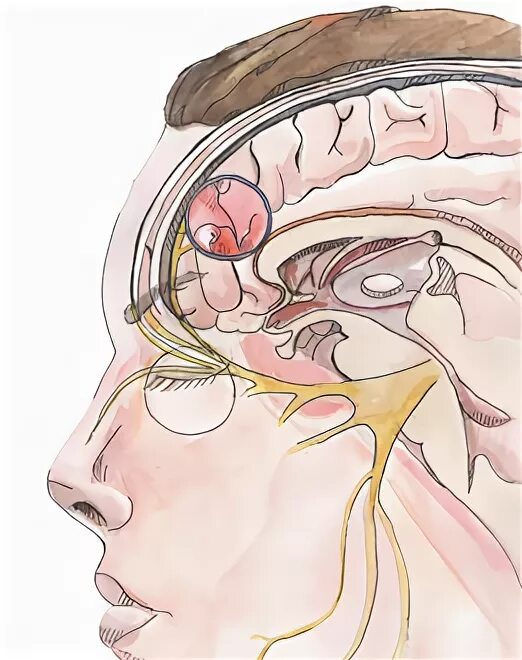 Ликворные пространства болит голова. Заболевание головы внутри. Опухоль мозга выдавливает глаза. Холод внутри головы