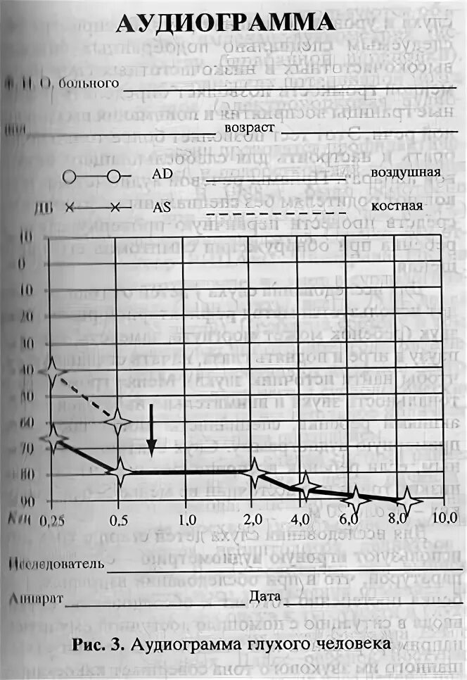 Аудиограмма степени. Аудиограмма 4 степени тугоухости. Тональная пороговая аудиограмма норма. Аудиограмма 1 степени тугоухости. Кондуктивная тугоухость 3 степени аудиограмма.