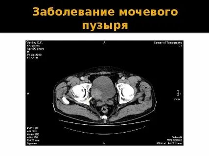Кт мочевого пузыря