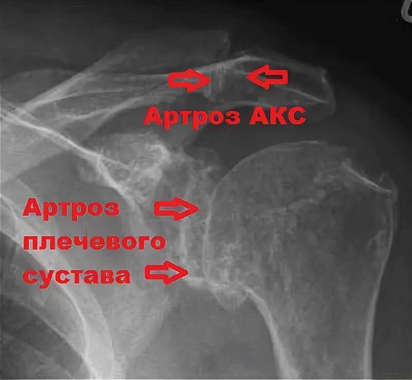 Лечение ключично акромиального артроза. Деформирующий артроз плечевого сустава рентген. Деформирующий артроз плечевого сустава рентген заключение. Артроз акромиально-ключичного сустава рентген. Артроз акс плечевого сустава рентген.