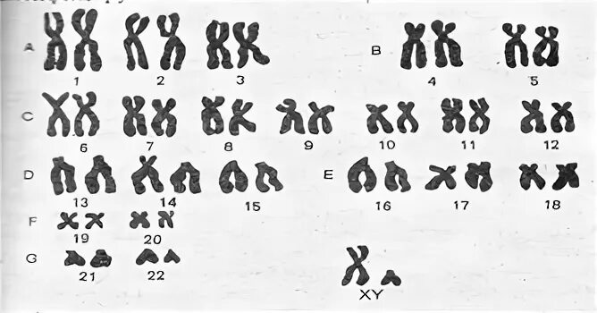 Хромосом группы d. Кариотип человека классификация хромосом человека. Классификация хромосом в кариотипе человека. Кариотип и идиограмма хромосом человека. Денверская и Парижская классификация хромосом человека.